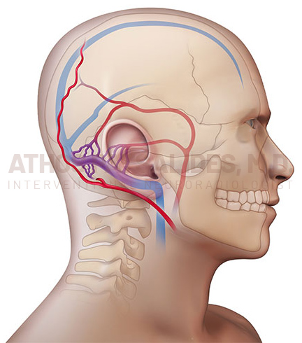 Dural Arteriovenous Fistulas